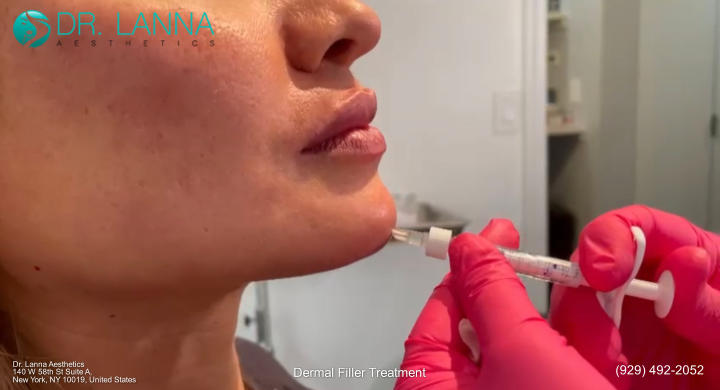 botox vs chin fillers treatment 