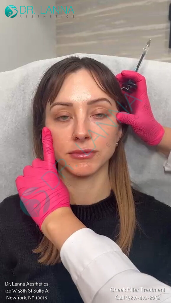 a woman getting cheek fillers