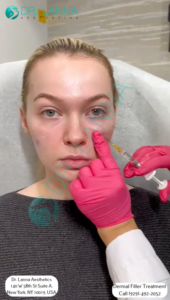 a woman had cheek filler treatment at Dr. Lanna's clinic