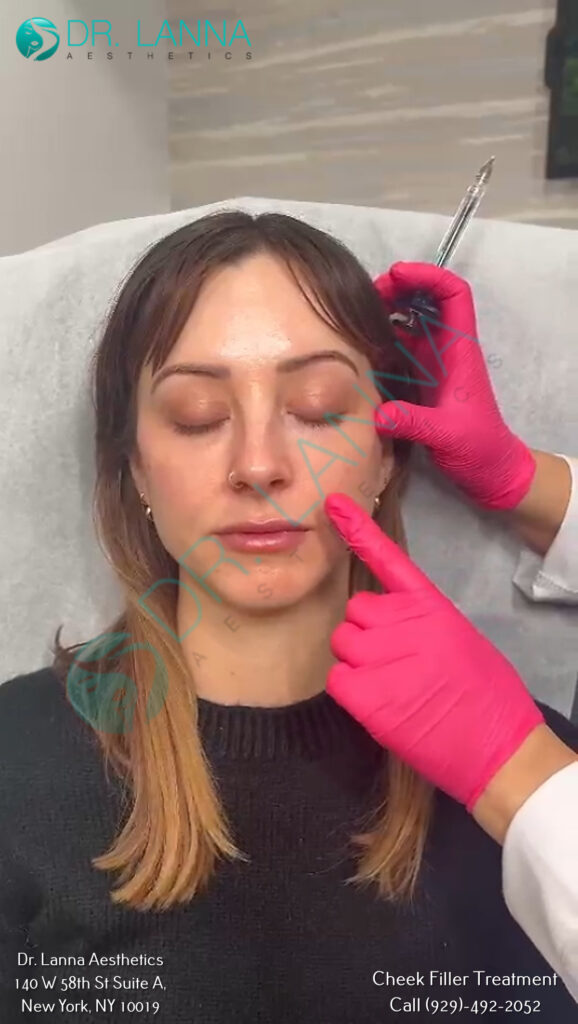 cheek filler treatment