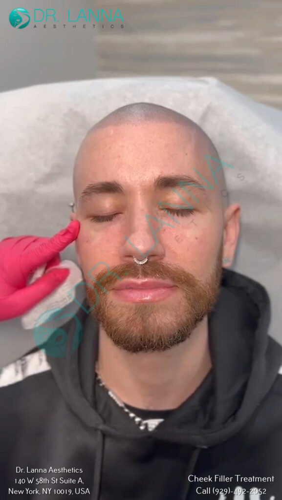 cheek filler results