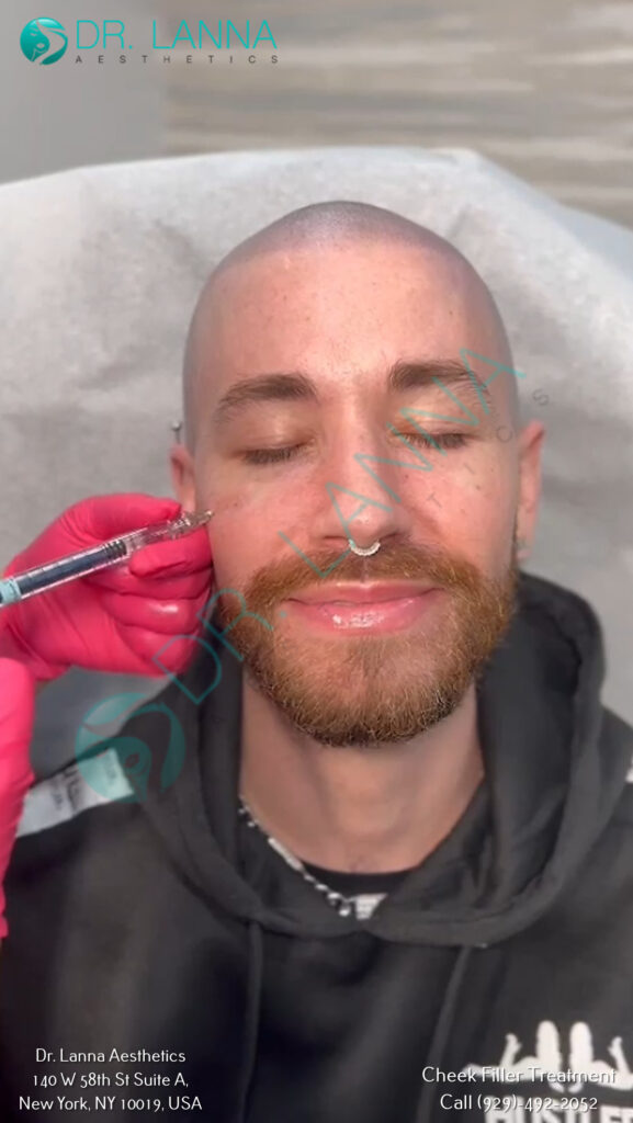 Cheek Filler Treatment at Dr. Lanna Aesthetics