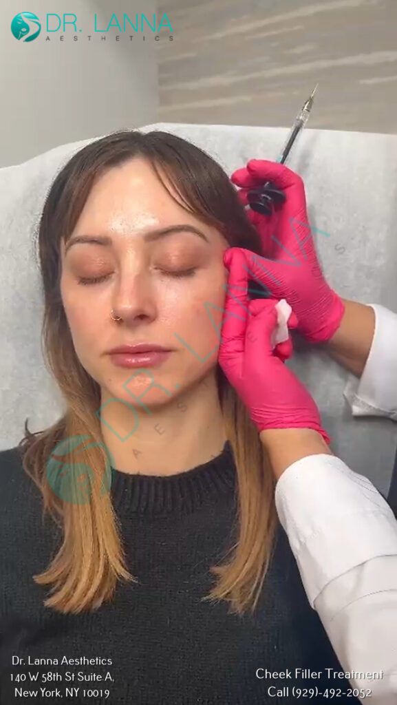 Client receiving a cheek filler injection with a pen at Dr. Lanna Aesthetics, NYC