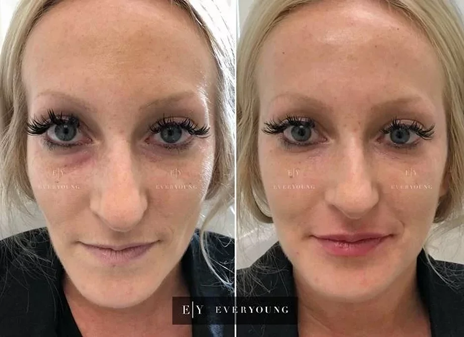 A woman getting cheek fillers