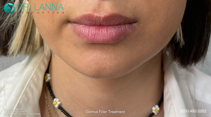 woman who had chin fillers