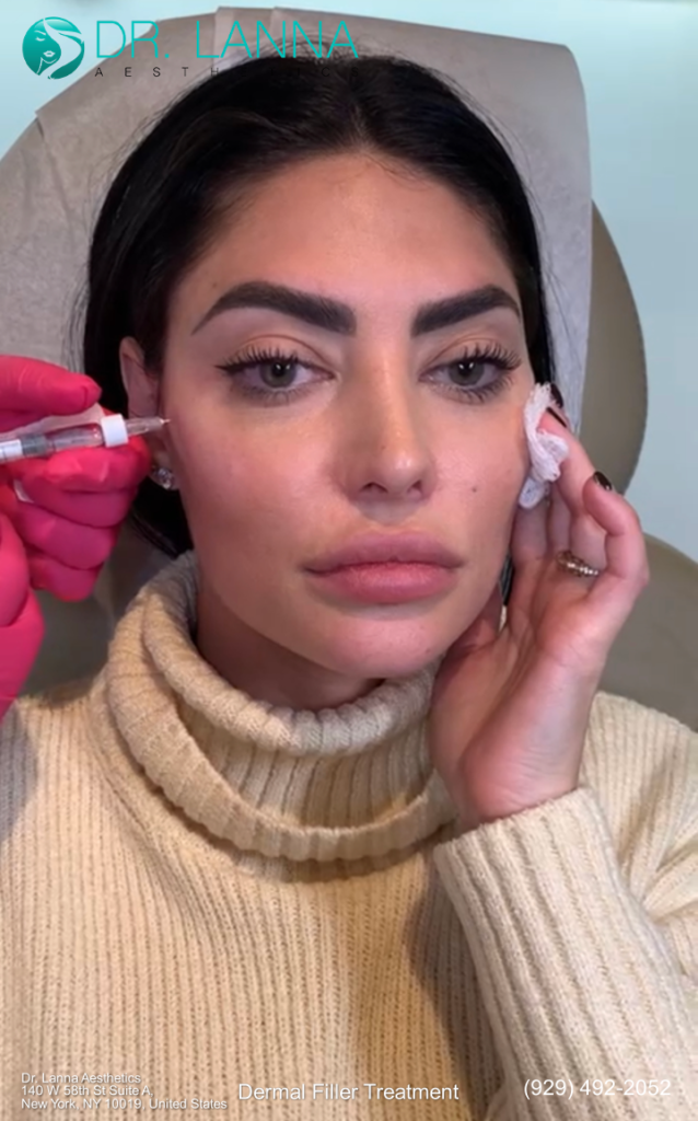 a woman received dermal filler treatment at Dr. Lanna's clinic