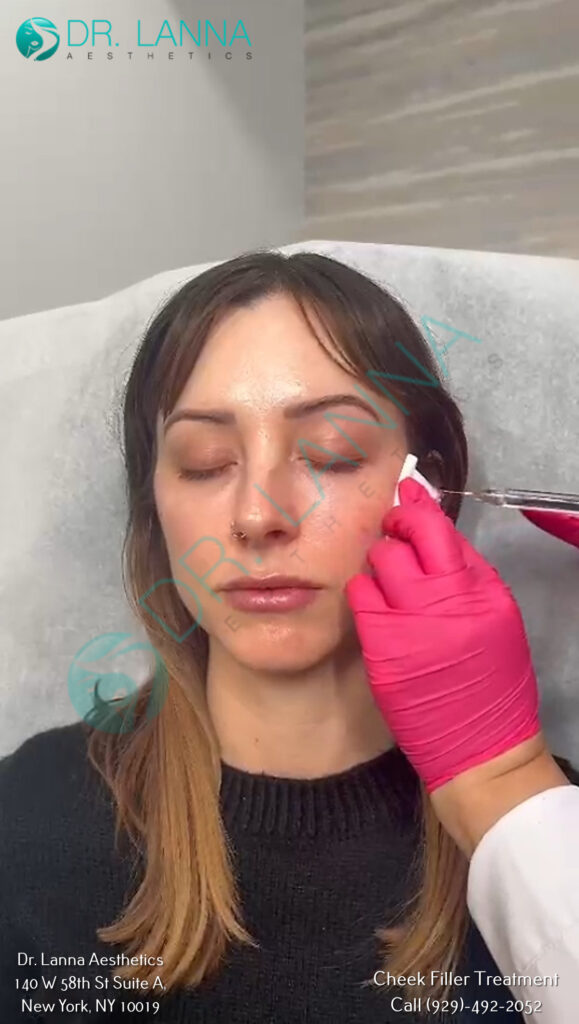 Cheek Filler Treatment at Dr. Lanna Aesthetics