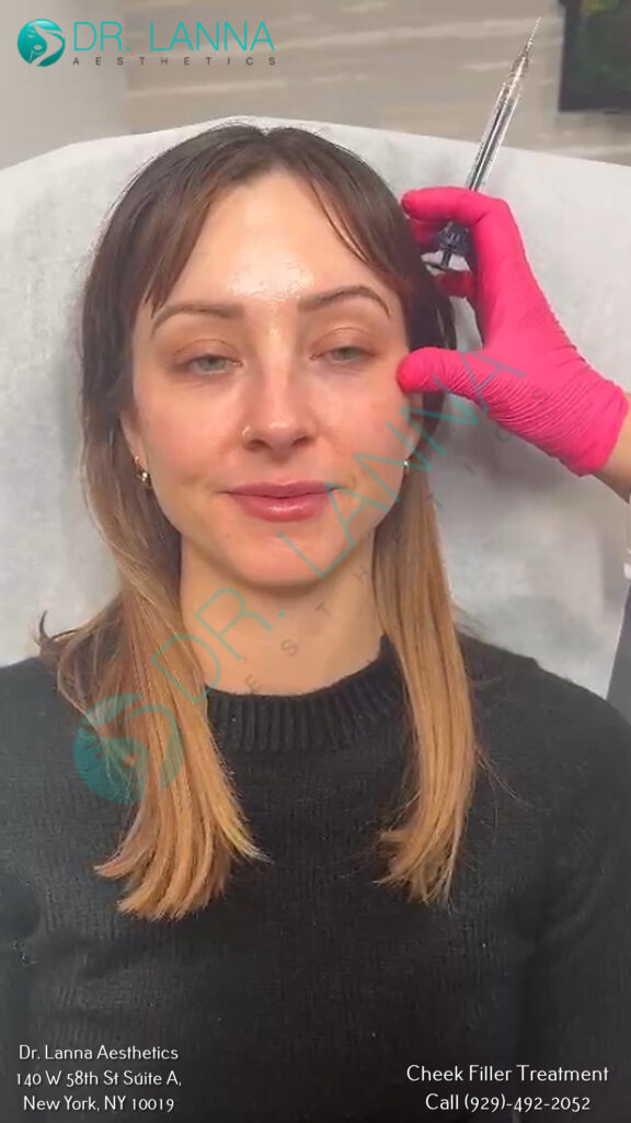 cheek filler treatment