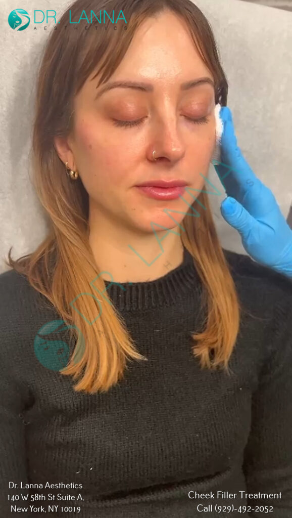 cheek filler results