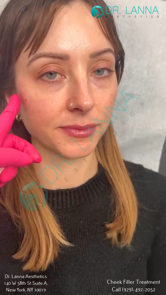 Cheek filler client portrait at Dr. Lanna Aesthetics in New York