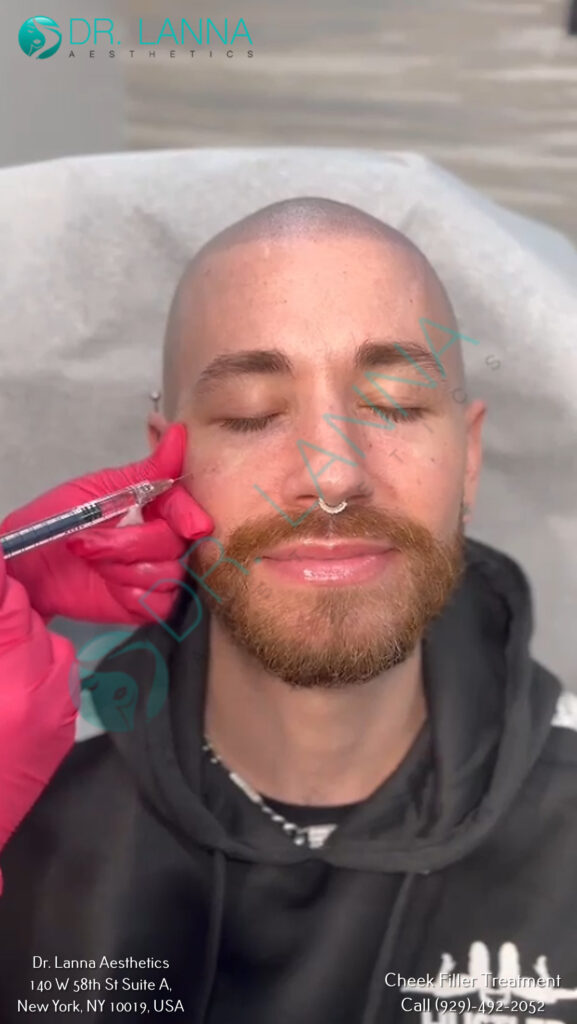 cheek filler results